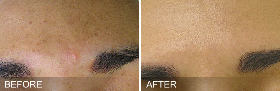 HydraFacial - Before & After for Brown Spots